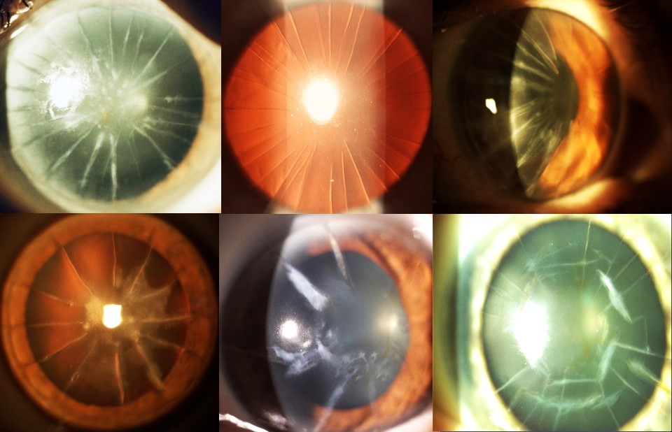 Collage of slit-lamp images showing multiple radial keratotomy eyes with corneal incisions, scars, irregular astigmatism, and visual distortion patterns affecting vision quality
