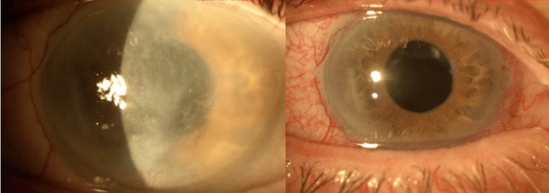 Corneal Scar Correction Jacksonville Gulani Vision Institute