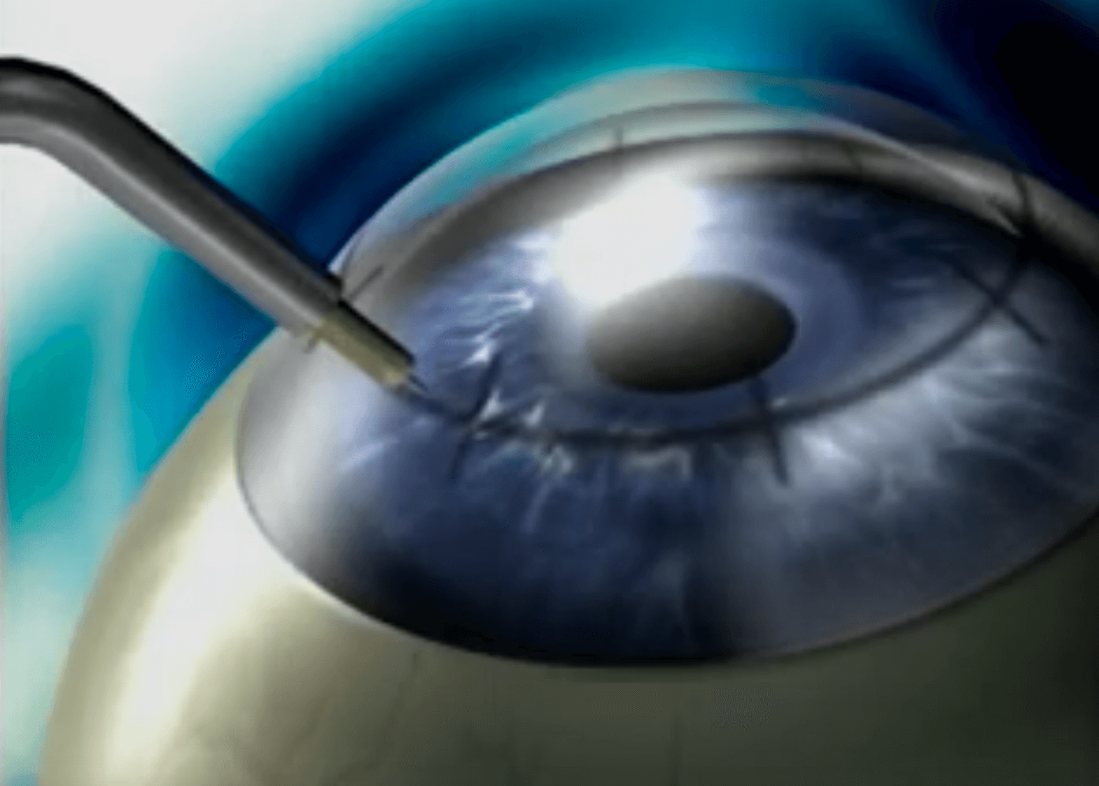 Conductive Keratoplasty (CK)