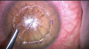 Hand Lamellar Keratoplasty