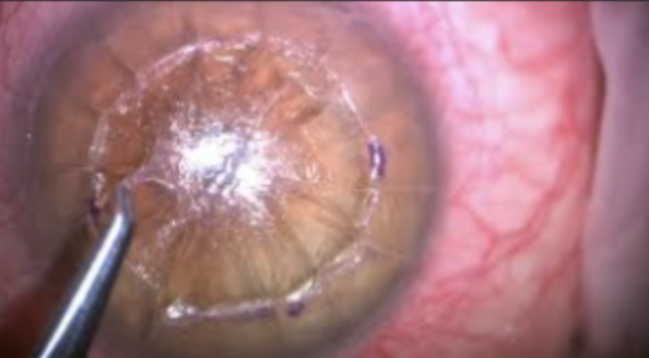 Hand Lamellar Keratoplasty