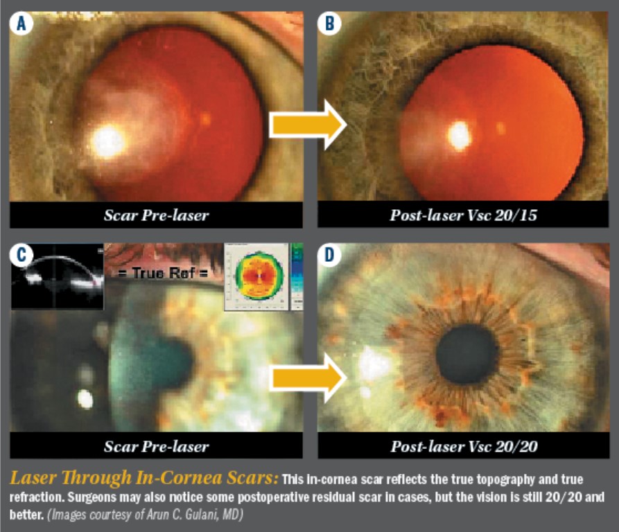 Laser through in-cornea scars
