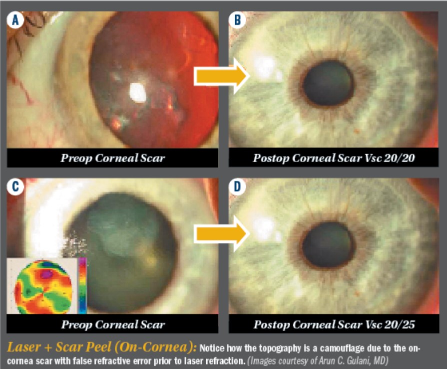 Laser + Scar Peel (On-Cornea)