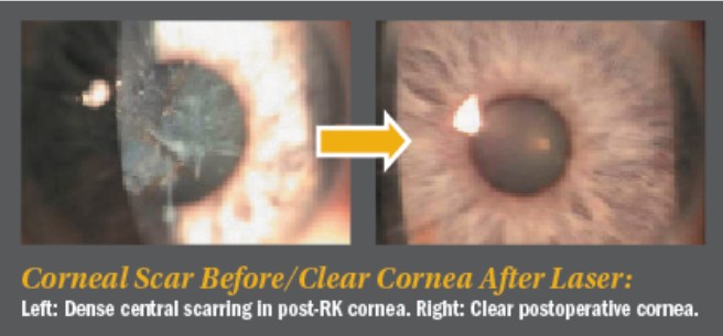 Corneal scar before/Clear cornea after laser
