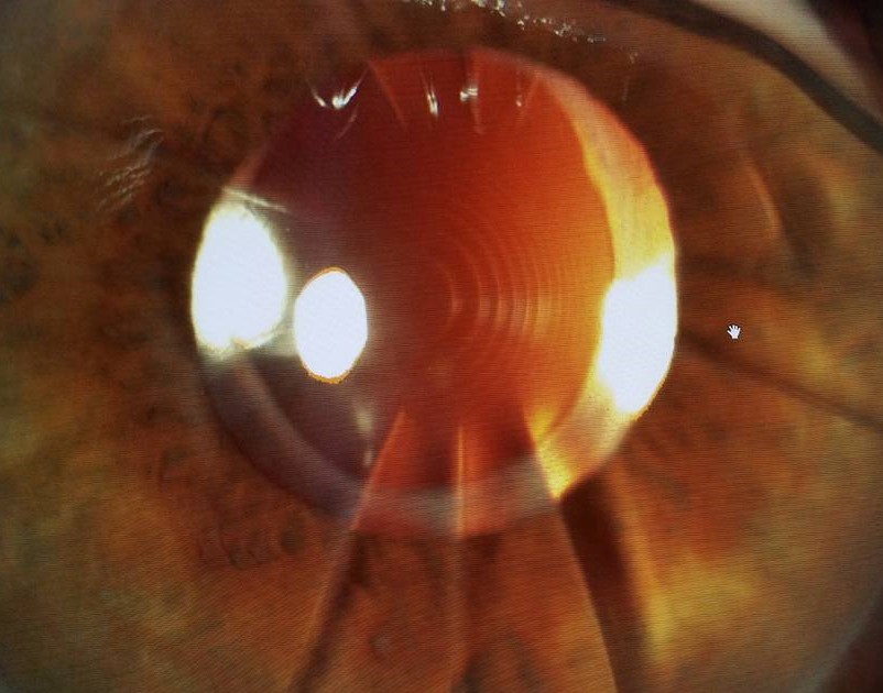 Dr. Arun C. Gulani, renowned eye surgeon, consulting with a patient who had undergone failed cataract surgery after previous Radial Keratotomy (RK). This image showcases personalized care and advanced techniques like Corneoplastique™, LenzOplastique™, and LazrPlastique™ used to restore 20/20 vision in complex, post-RK eyes.
