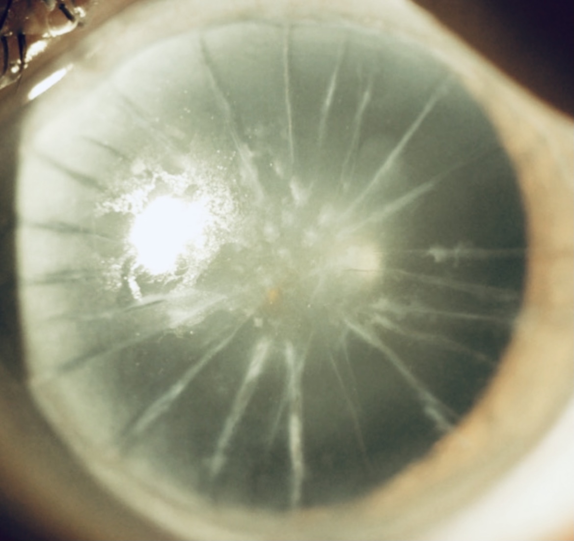Slit-lamp photograph of an eye with previous Radial Keratotomy (RK) showing multiple RK incisions associated with irregular corneal optics, fluctuating vision, ghosting, irregular astigmatism and complex corneal rehabilitation.