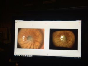 Before and after eye scan showing vision restored after corrective surgery by Dr. Gulani.
