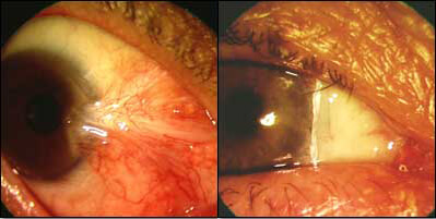 Before and After Eye Surgery