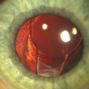 Displaced Lens