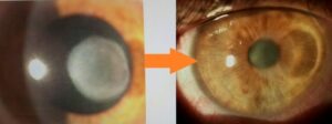 Close-up of an eye after corneal scar surgery, showing improved clarity and smooth corneal surface following advanced corneal scar treatment.