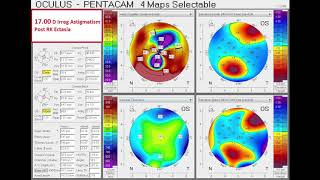 Idaho Physician's Cataract & RK Complication Corrected to 20/20