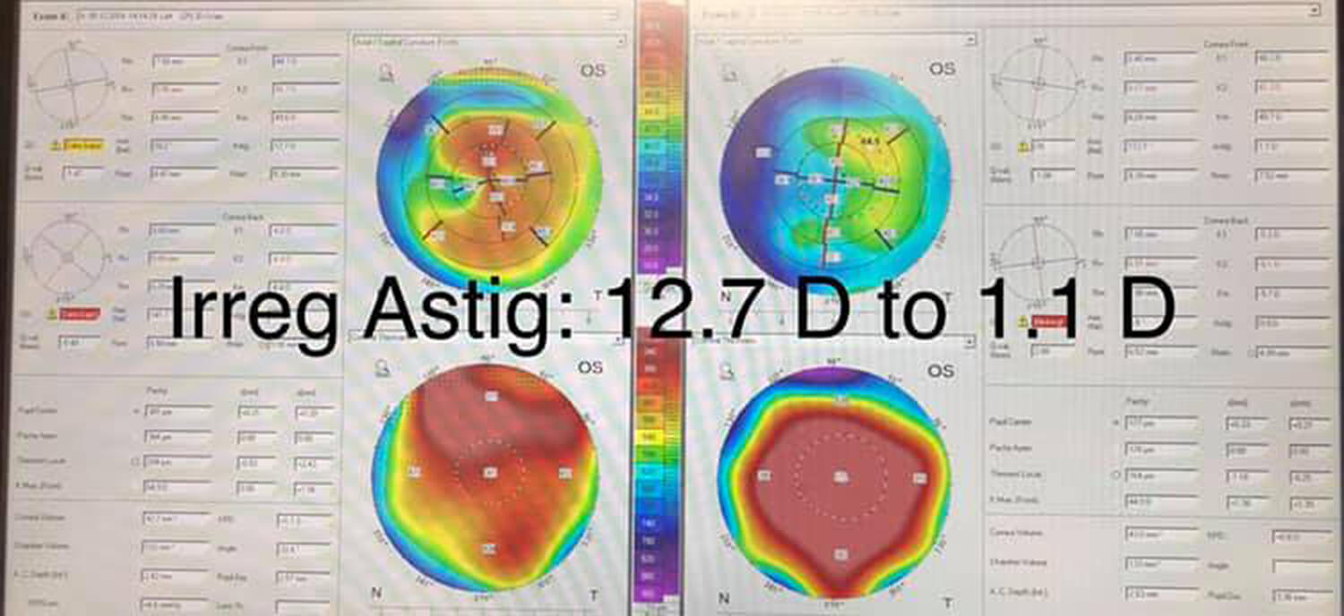 Irreg Astig: 12.7 D to 1.1 D